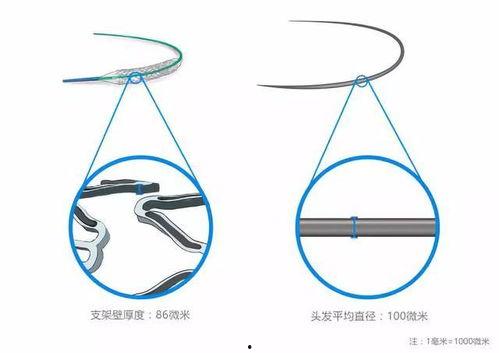 国产火鹰支架视频,创新引领心血管介入治疗新篇章  第2张
